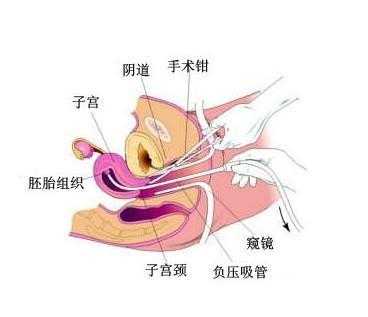 淮北流产打胎手术多少钱（淮南流产多少钱）-图3